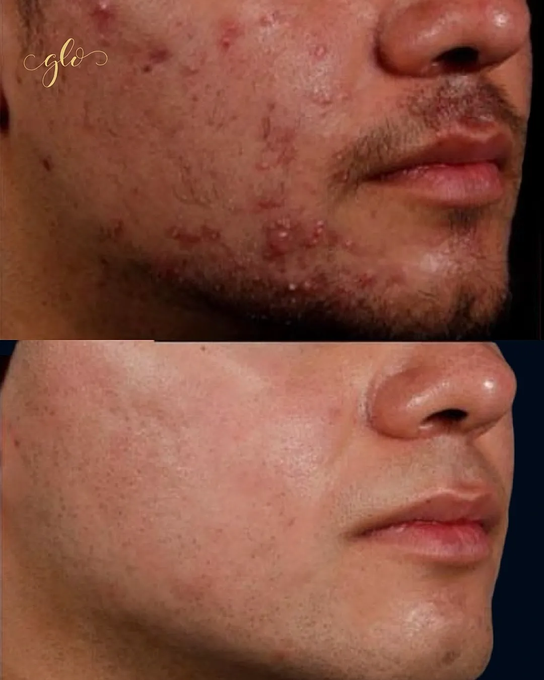 Before and after acne treatment results.