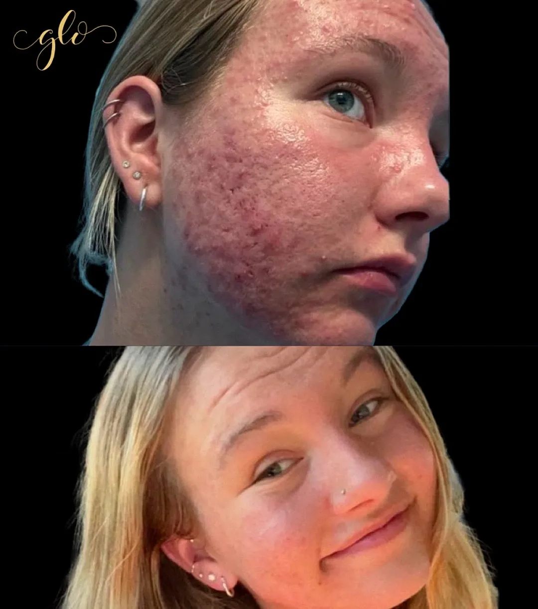 Before and after skincare treatment results.
