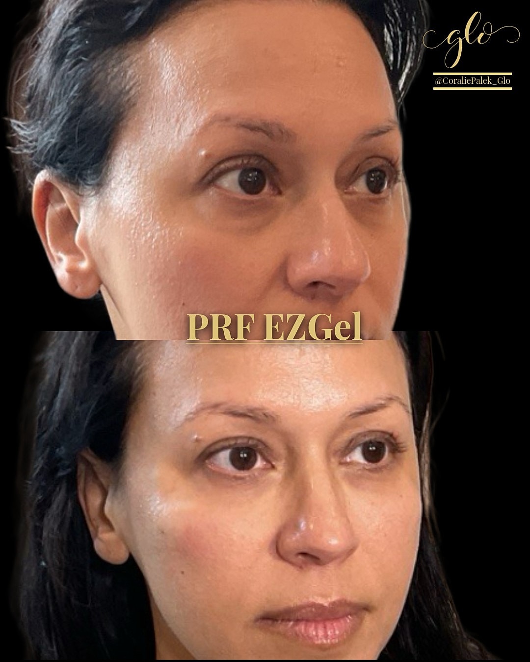 PRF EzGel Gallery Before & After