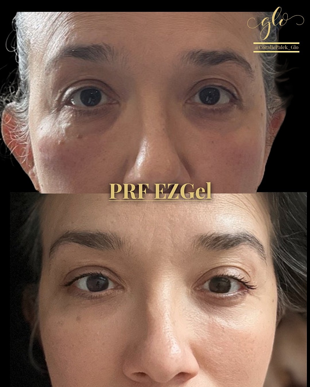 PRF EzGel Gallery Before & After