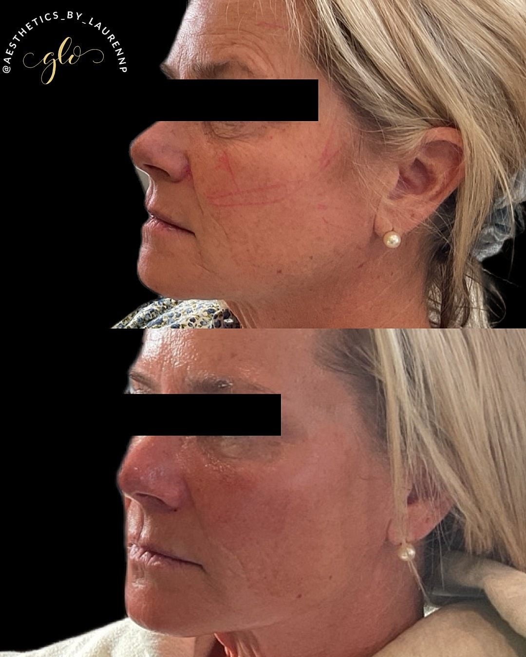 Sculptra Gallery Before & After
