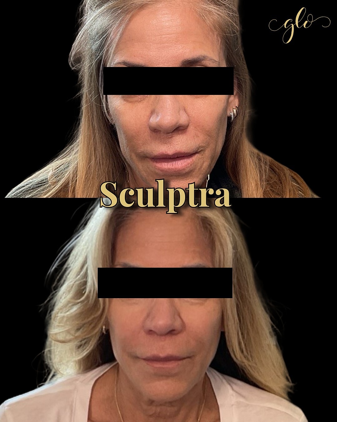 Sculptra Gallery Before & After