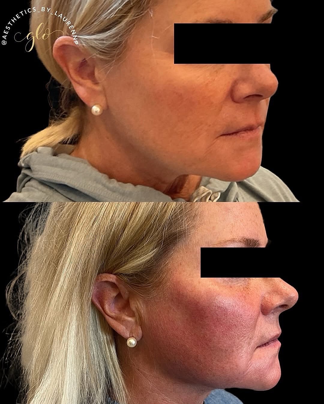 8 Point Sculpt Before & After