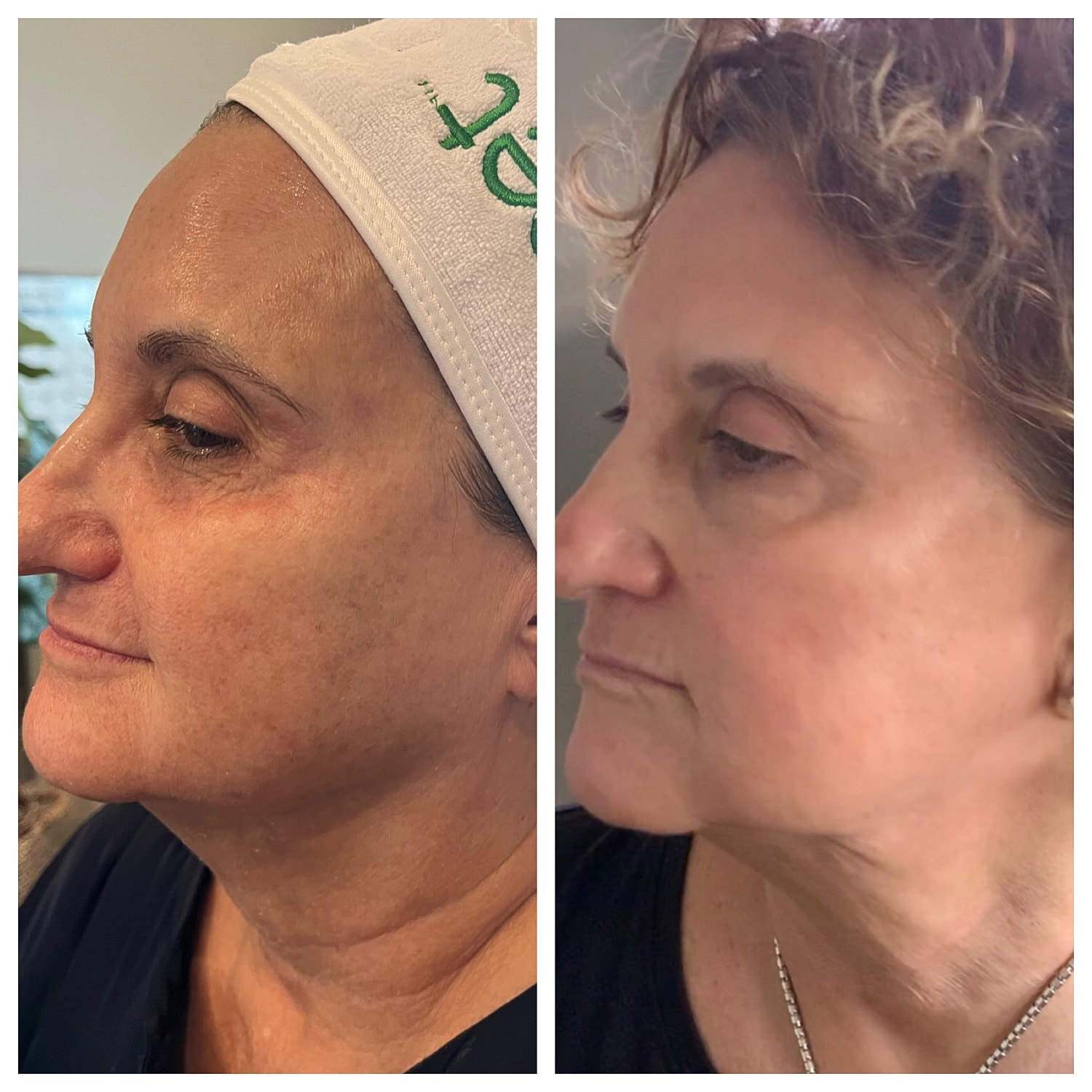CO₂ Laser Skin Resurfacing Before & After