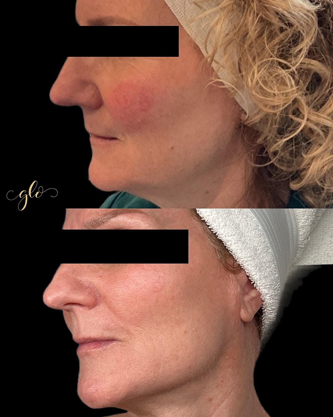 BBL Gallery Before & After