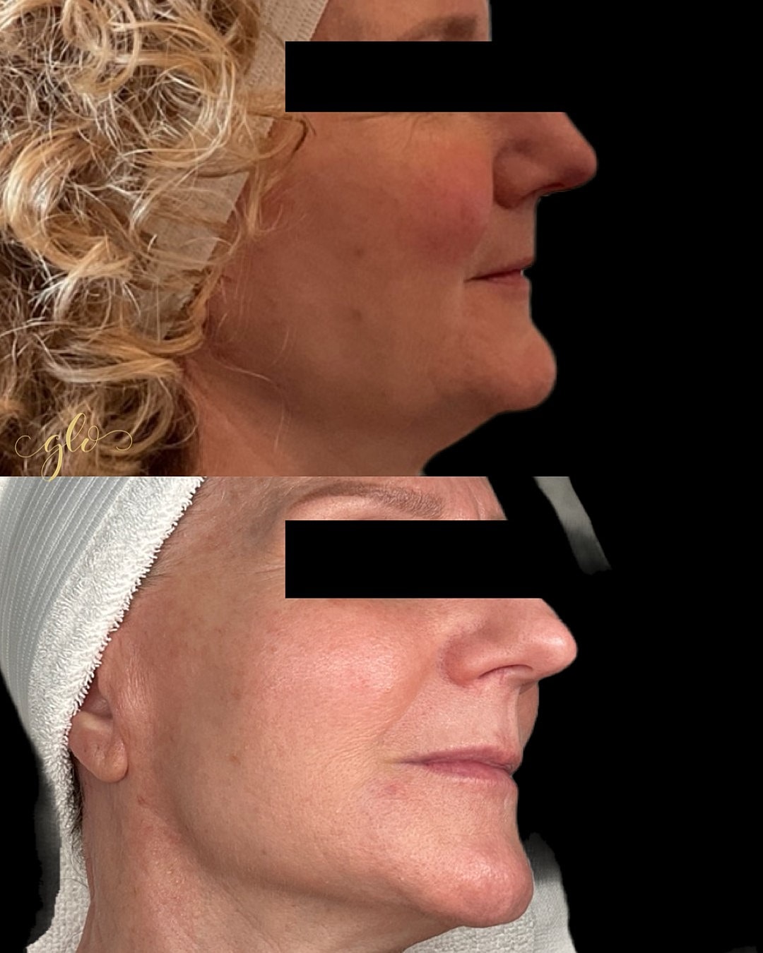 BBL Gallery Before & After