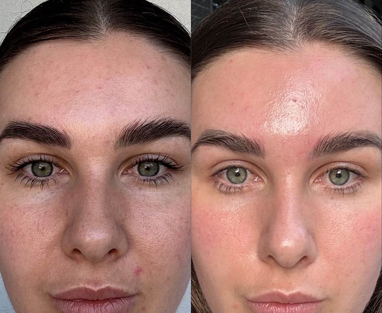 Laser Genesis Gallery Before & After