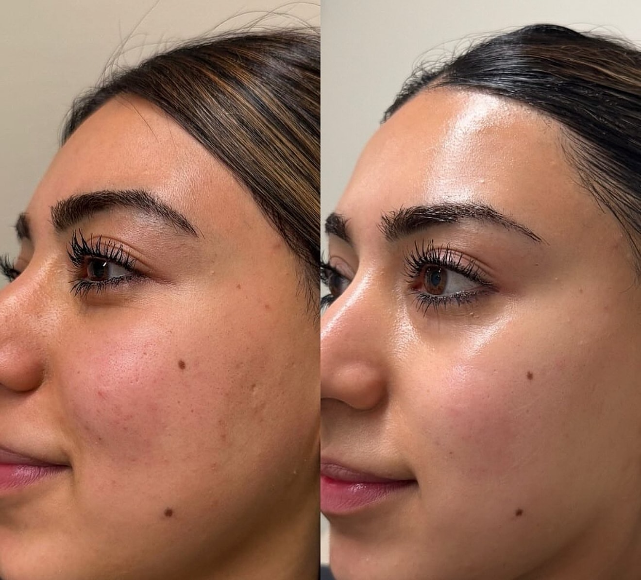 Laser Genesis Gallery Before & After