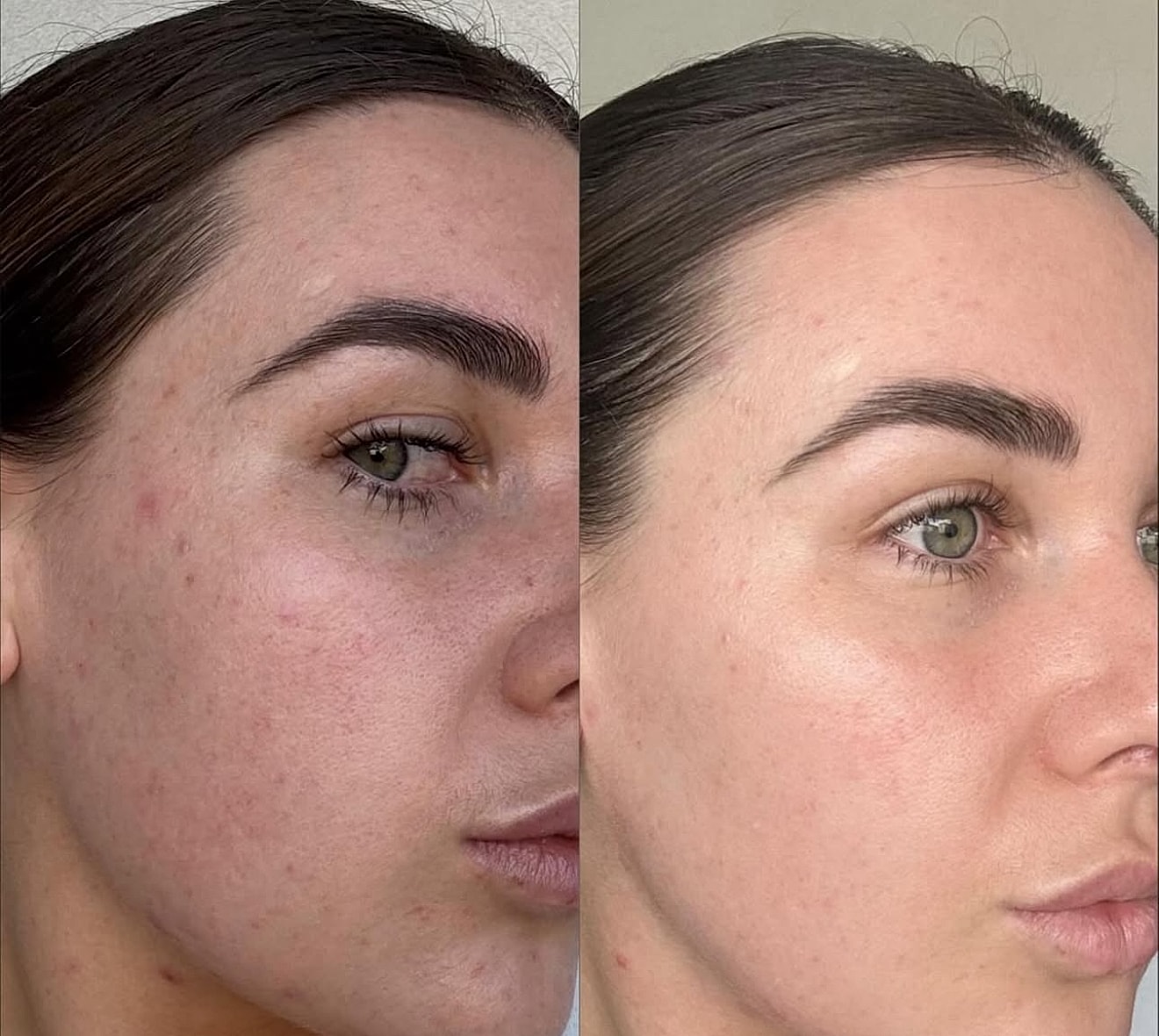 Laser Genesis Gallery Before & After