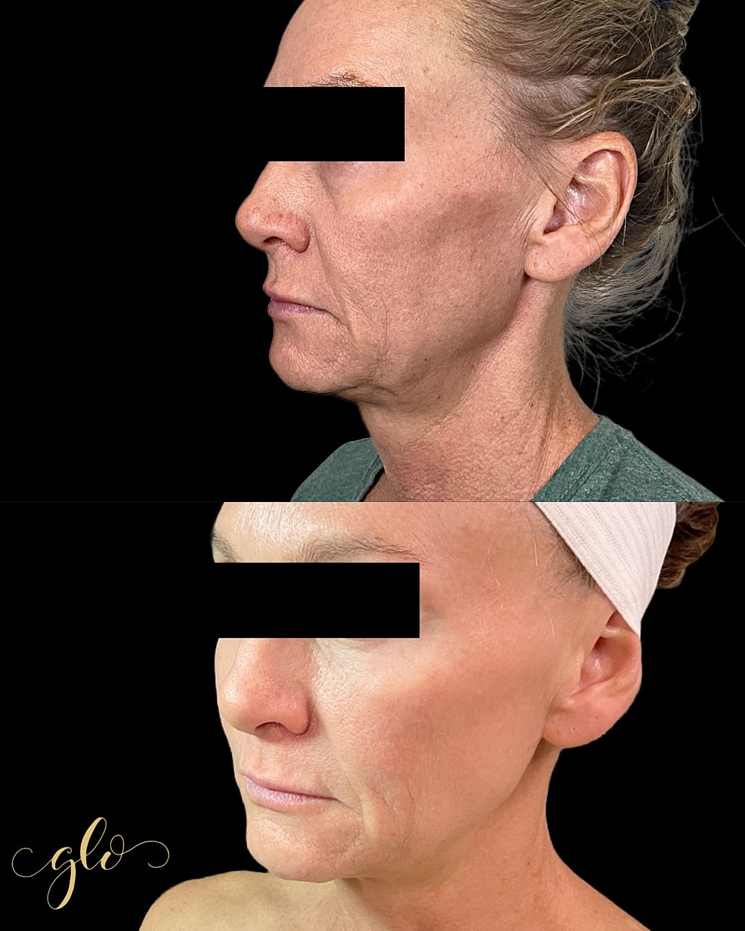 Glo Up Gallery Before & After