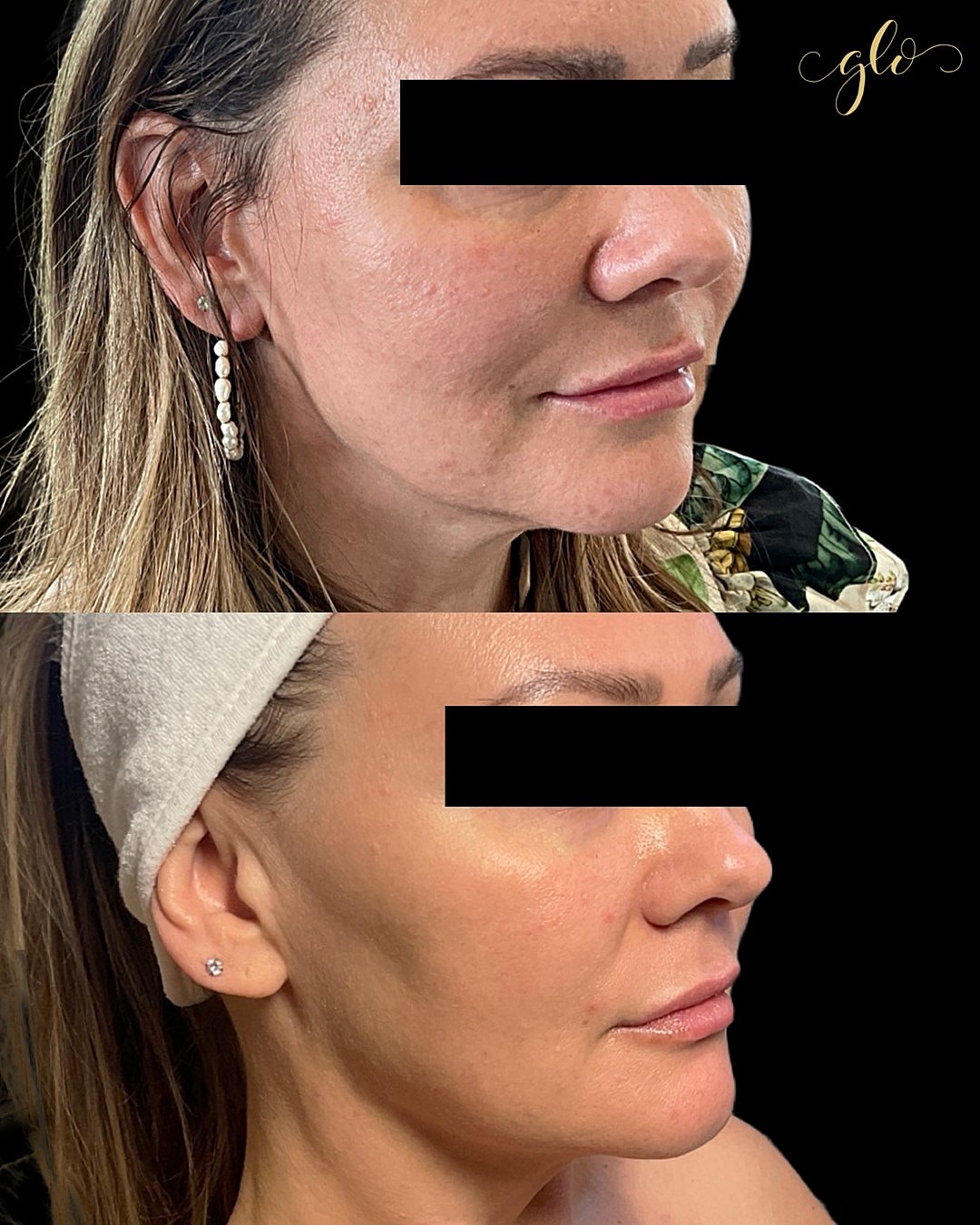 Glo Up Gallery Before & After