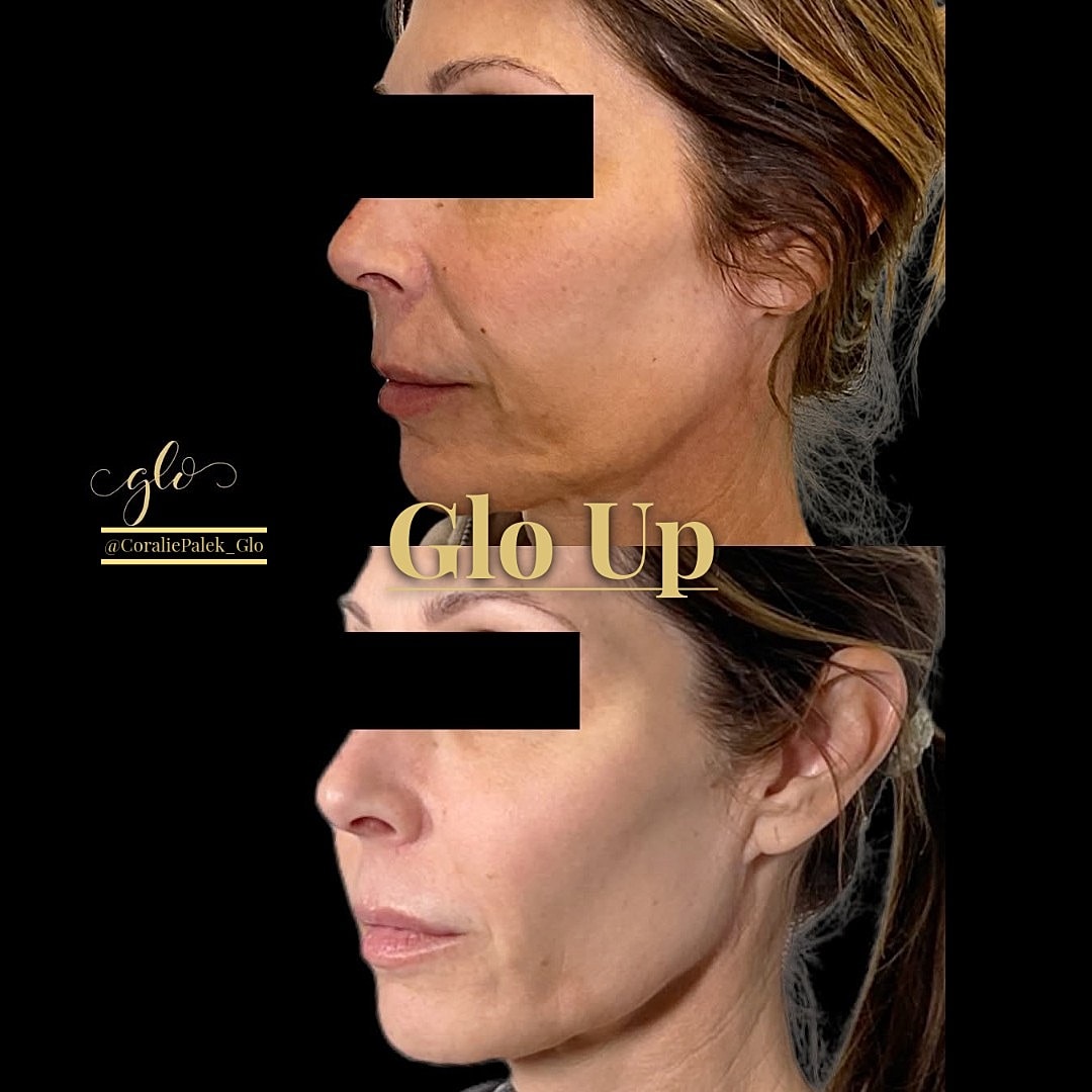 Glo Up Gallery Before & After