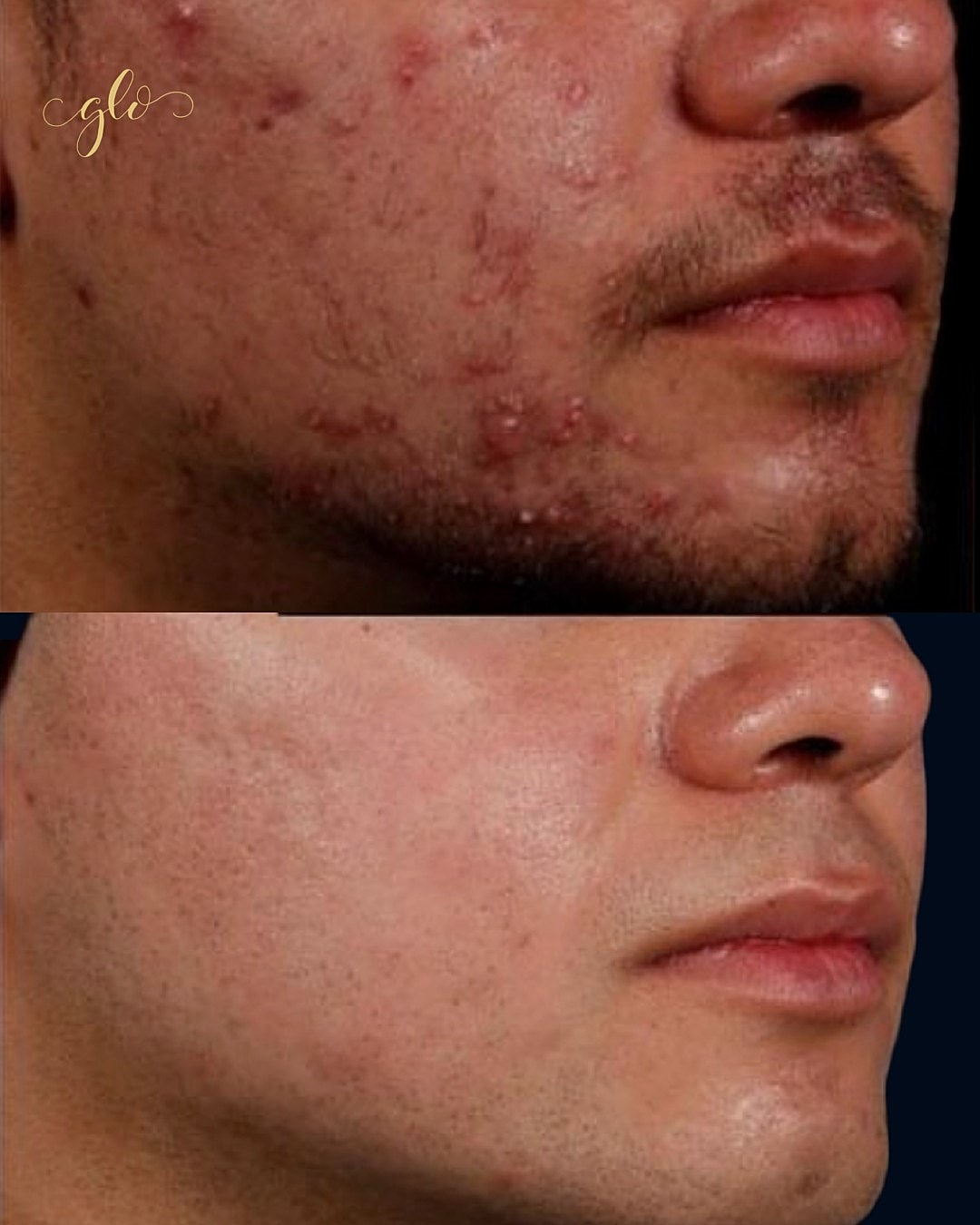 AviClear Gallery Before & After