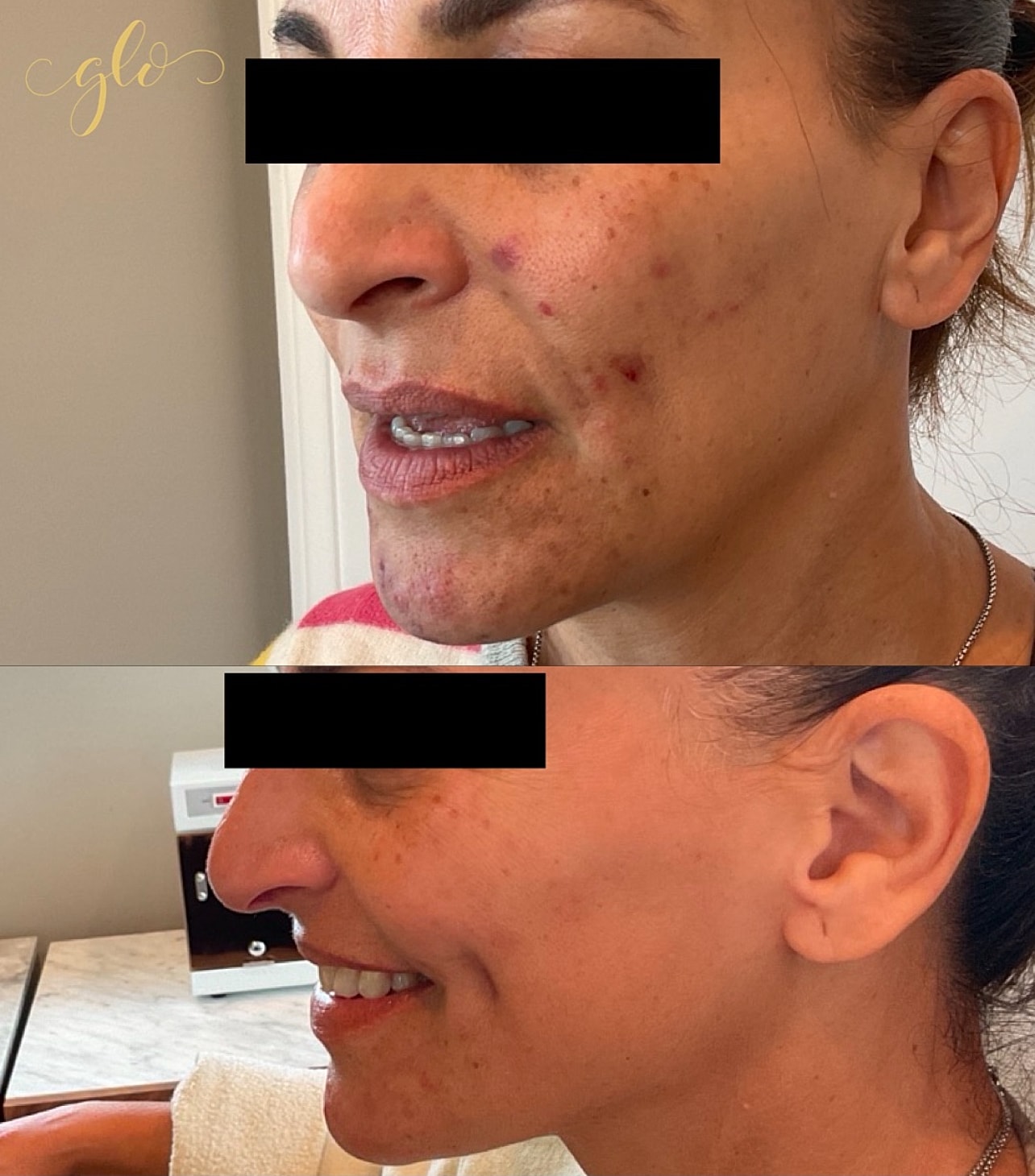 AviClear Gallery Before & After