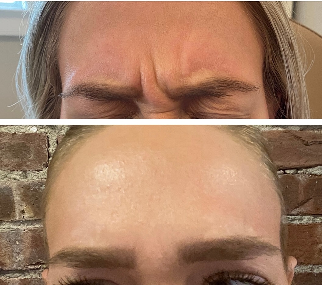 Botox Gallery Before & After