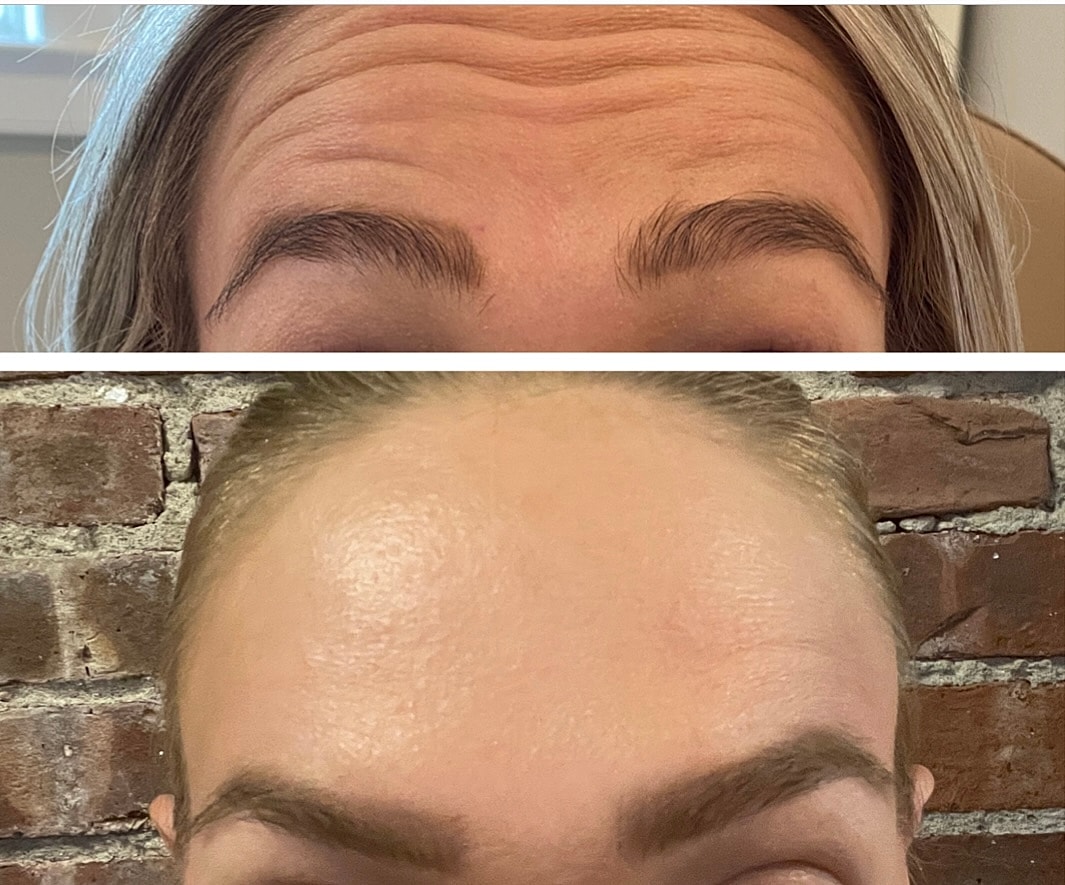 Botox Gallery Before & After