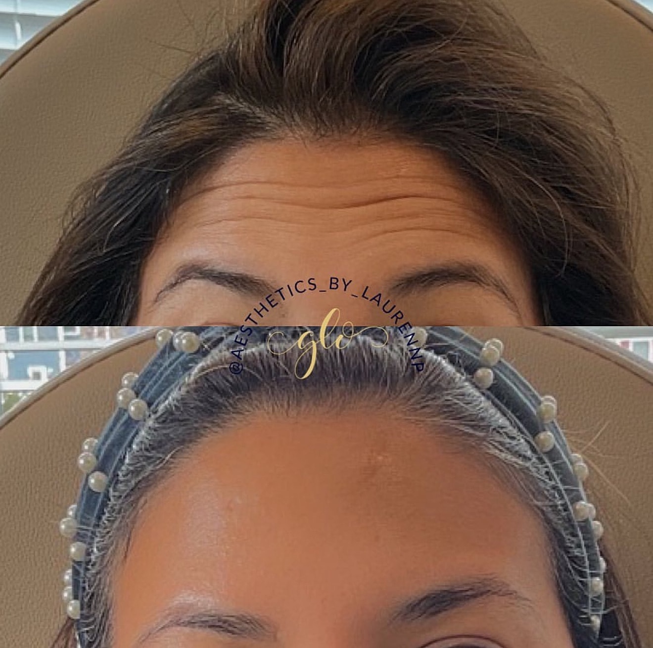 Botox Gallery Before & After