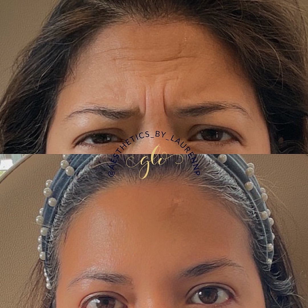 Botox Gallery Before & After