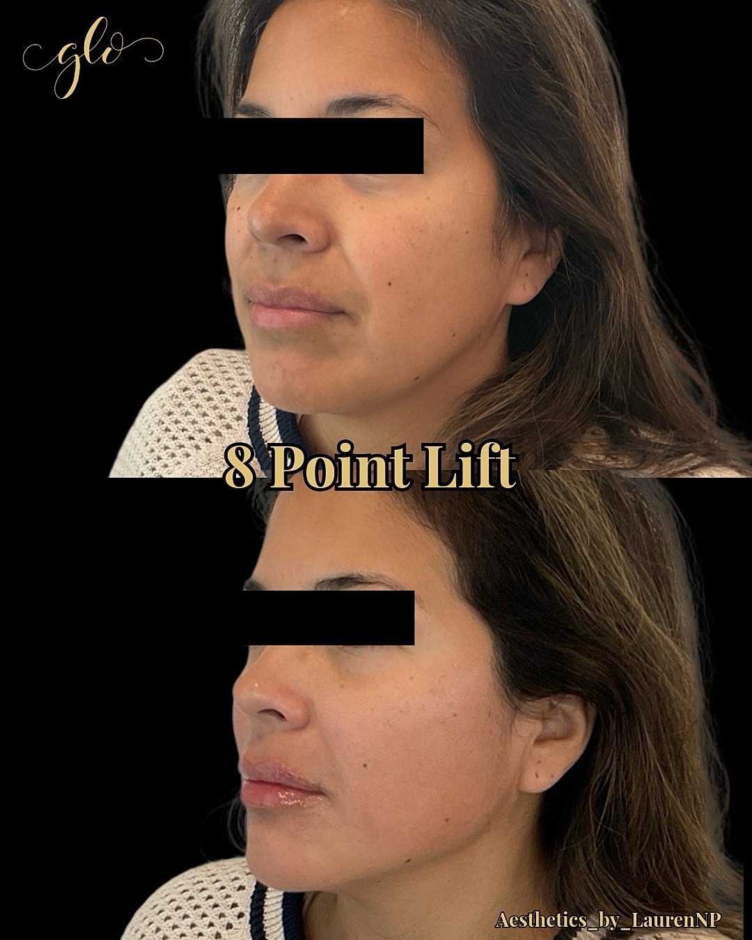 Before and after 8 point lift treatment