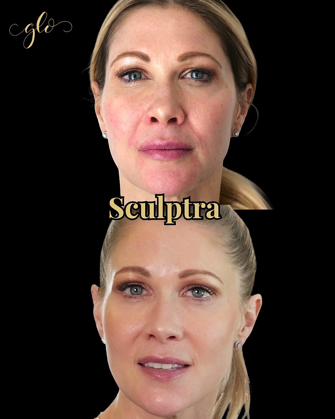 Before and after Sculptra treatment comparison.