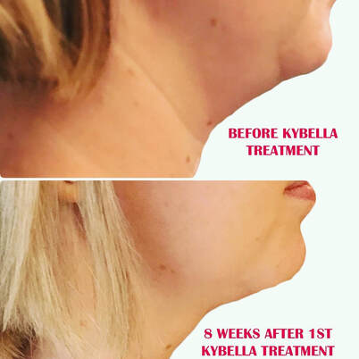 Kybella Treatment by Glo Aesthetics