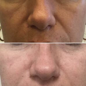 Dermal Filler Treatment by Glo Aesthetics