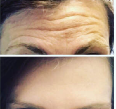 Botox & Drysport Treatment by Glo Esthetics