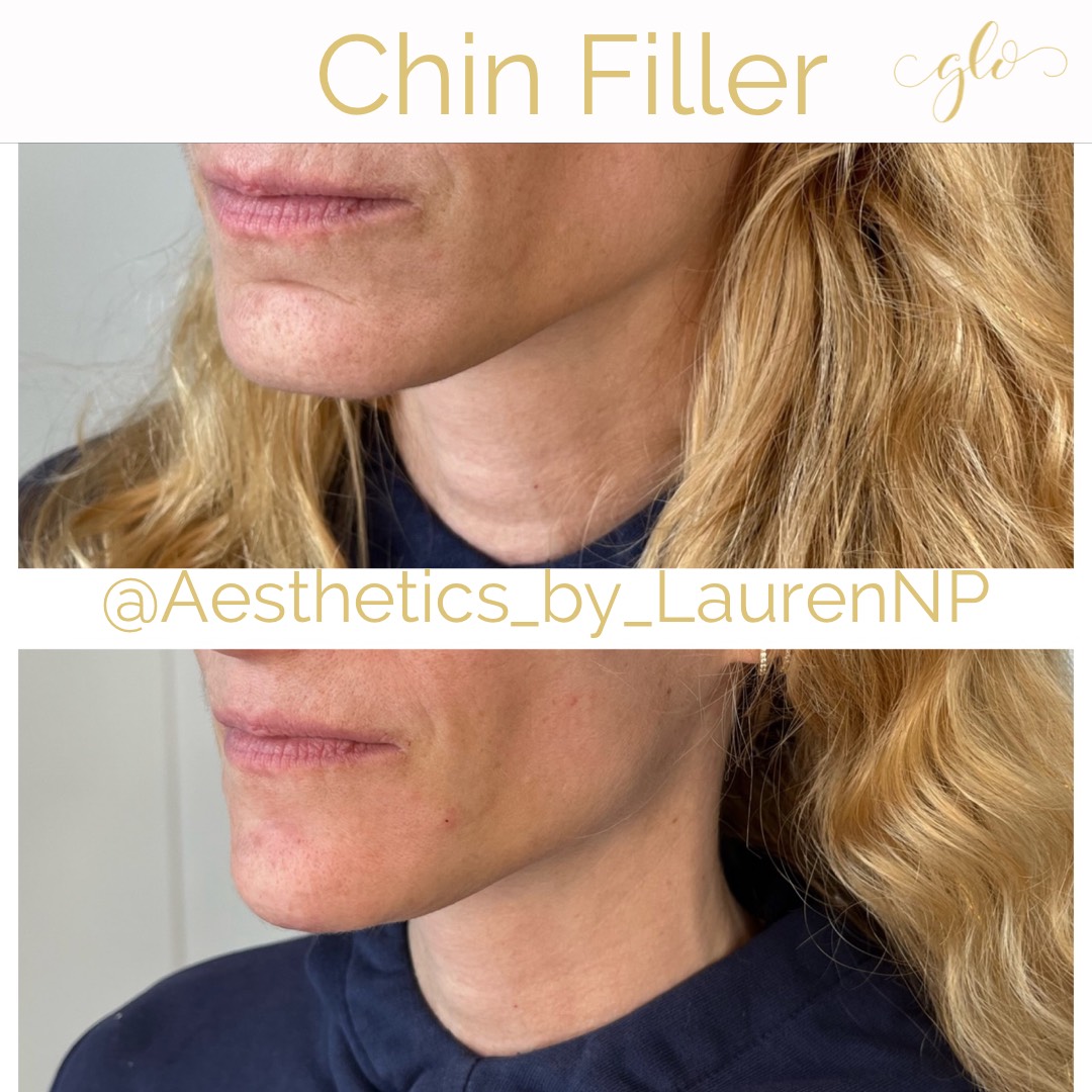 Dermal Filler Treatment by Glo Aesthetics