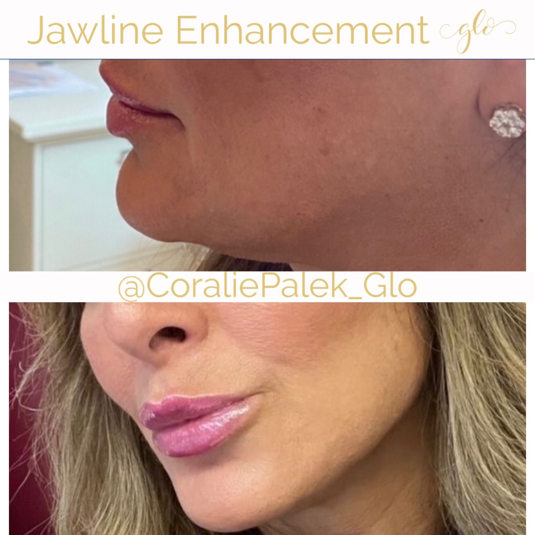 Dermal Filler Treatment by Glo Aesthetics