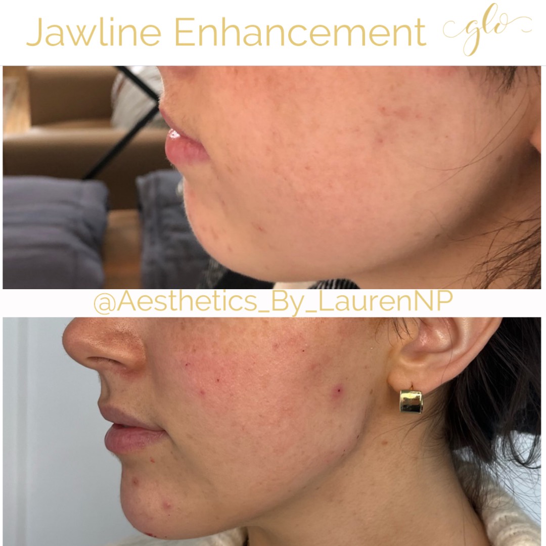 Dermal Filler Treatment by Glo Aesthetics