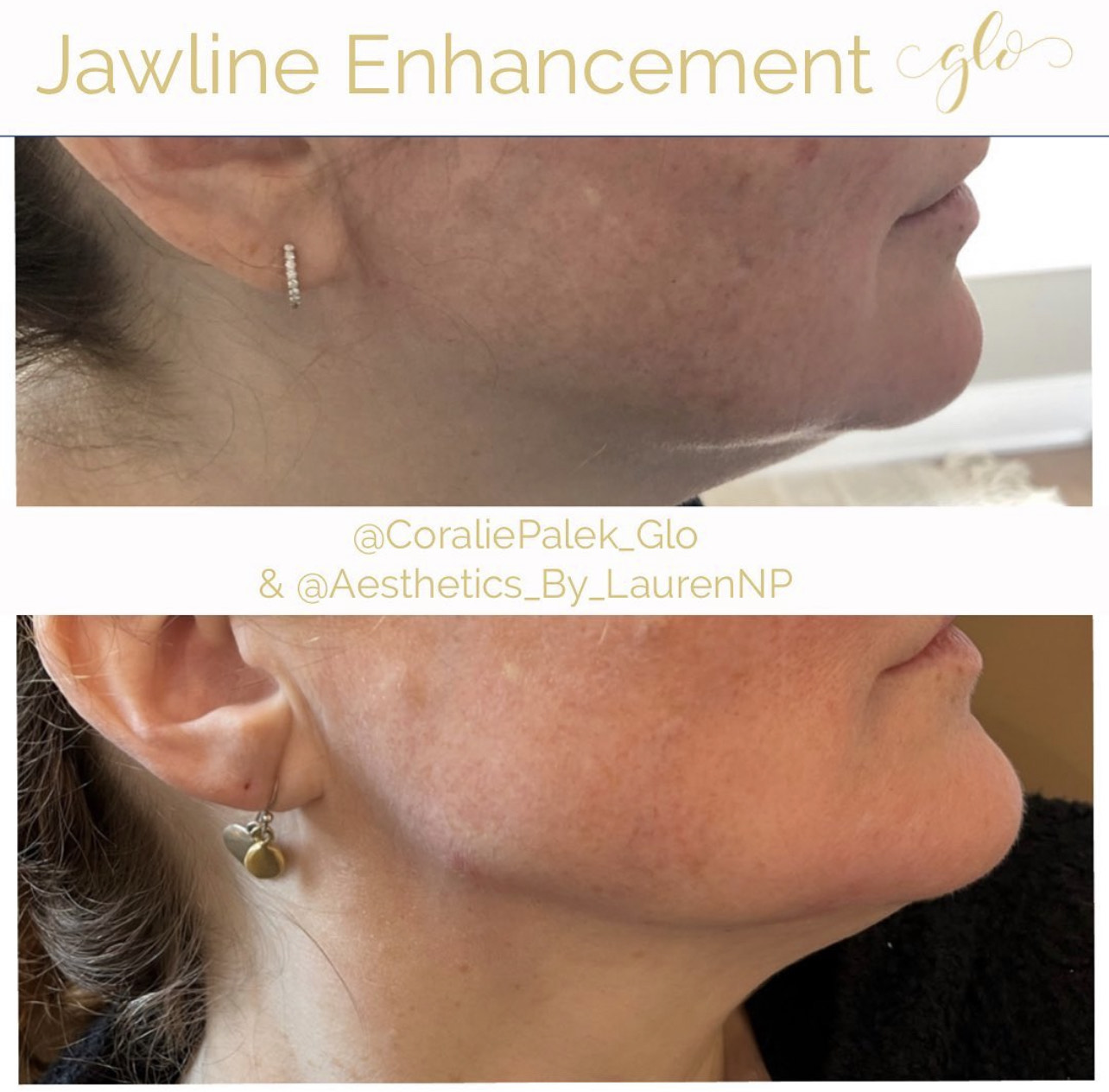 Dermal Filler Treatment by Glo Aesthetics