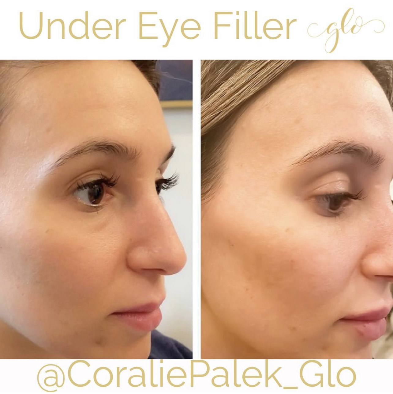 Dermal Filler Treatment by Glo Aesthetics