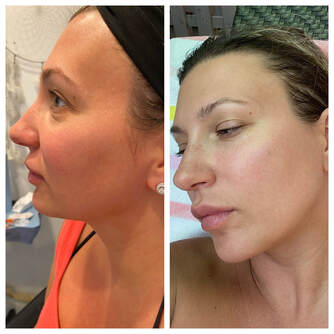 Dermal Filler Treatment by Glo Aesthetics