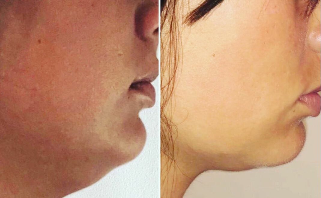 Kybella Treatment by Glo Aesthetics