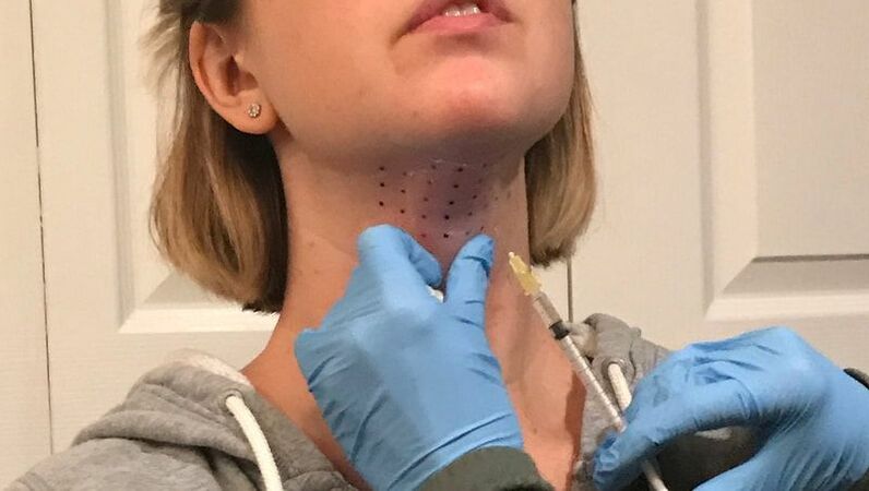 Kybella Treatment by Glo Aesthetics