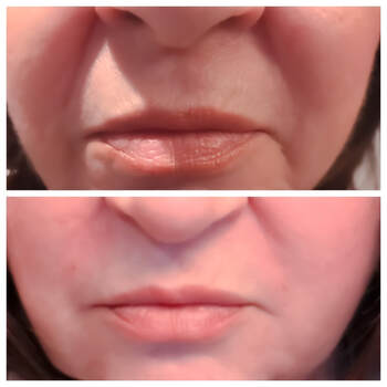 Dermal Filler Treatment by Glo Aesthetics