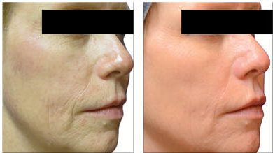 Skin Resurfacing Treatment by Glo Aesthetics