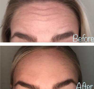 Botox & Dysport Treatment by Glo Esthetics