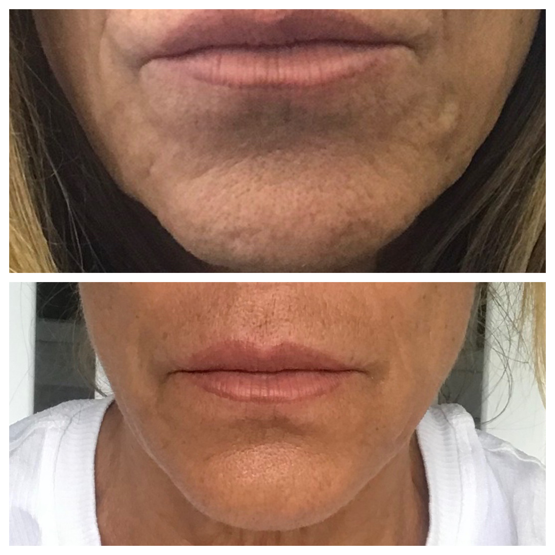 Skin Tightening Treatment by Glo Aesthetics