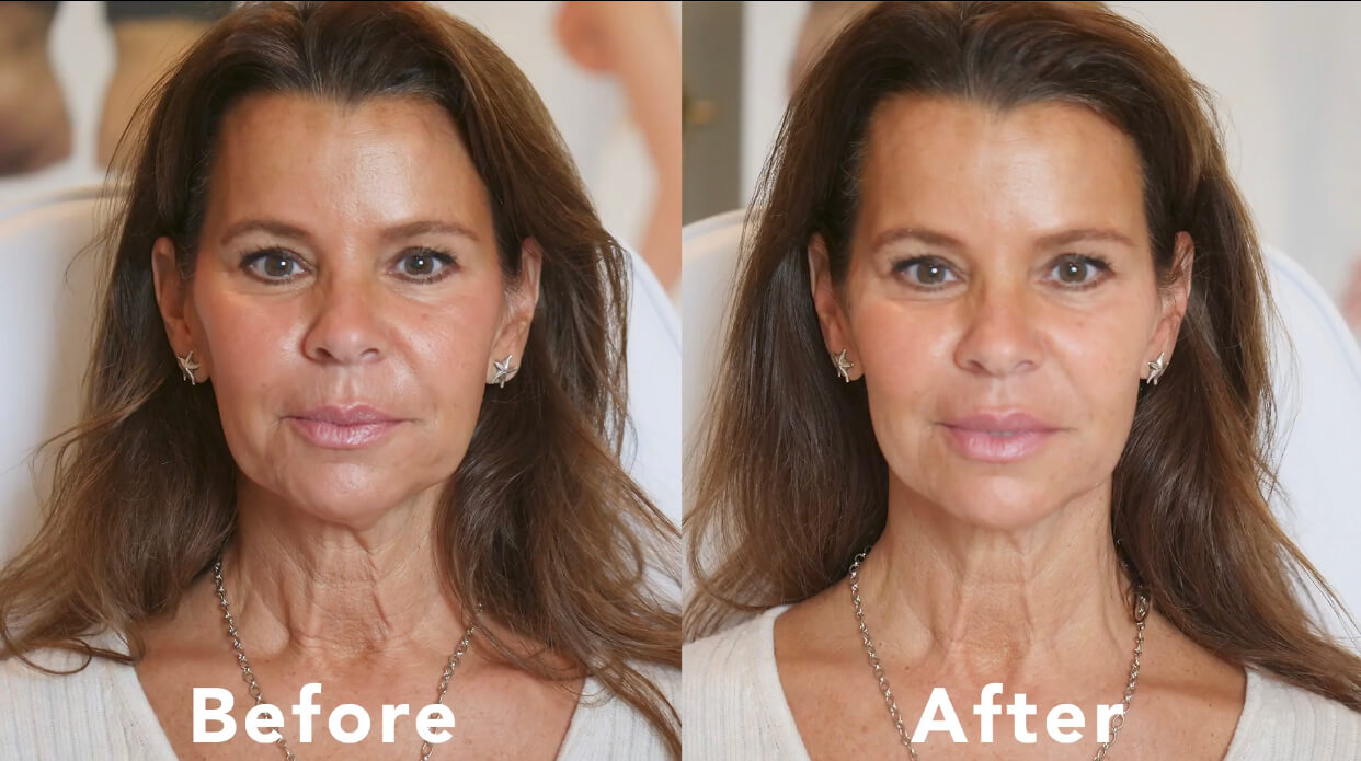 Threadlift Before and After Results by Glo Aesthetics