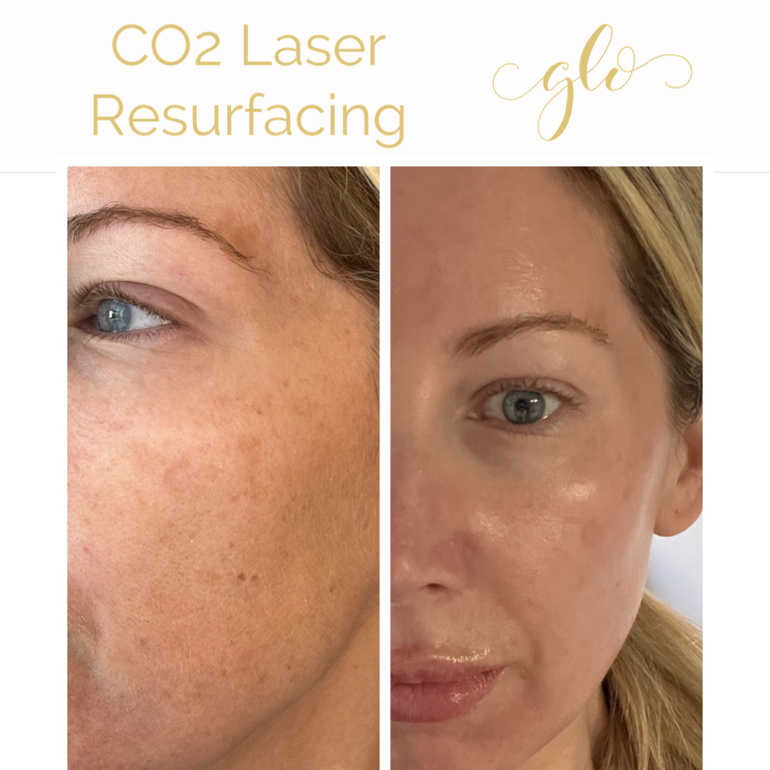 SecretPro – RF Microneedling & Co2 Laser Resurfacing