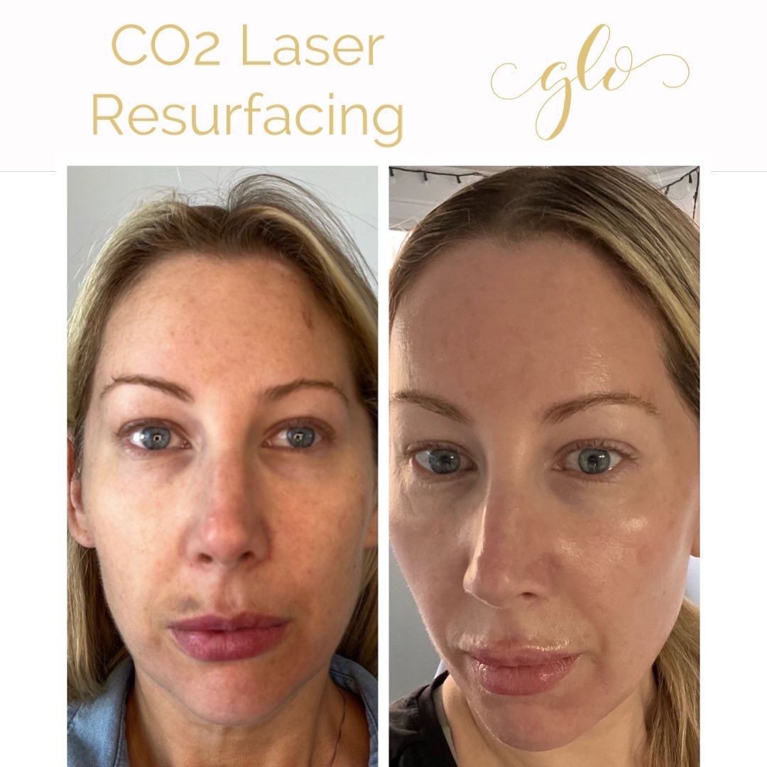 SecretPro – RF Microneedling & Co2 Laser Resurfacing