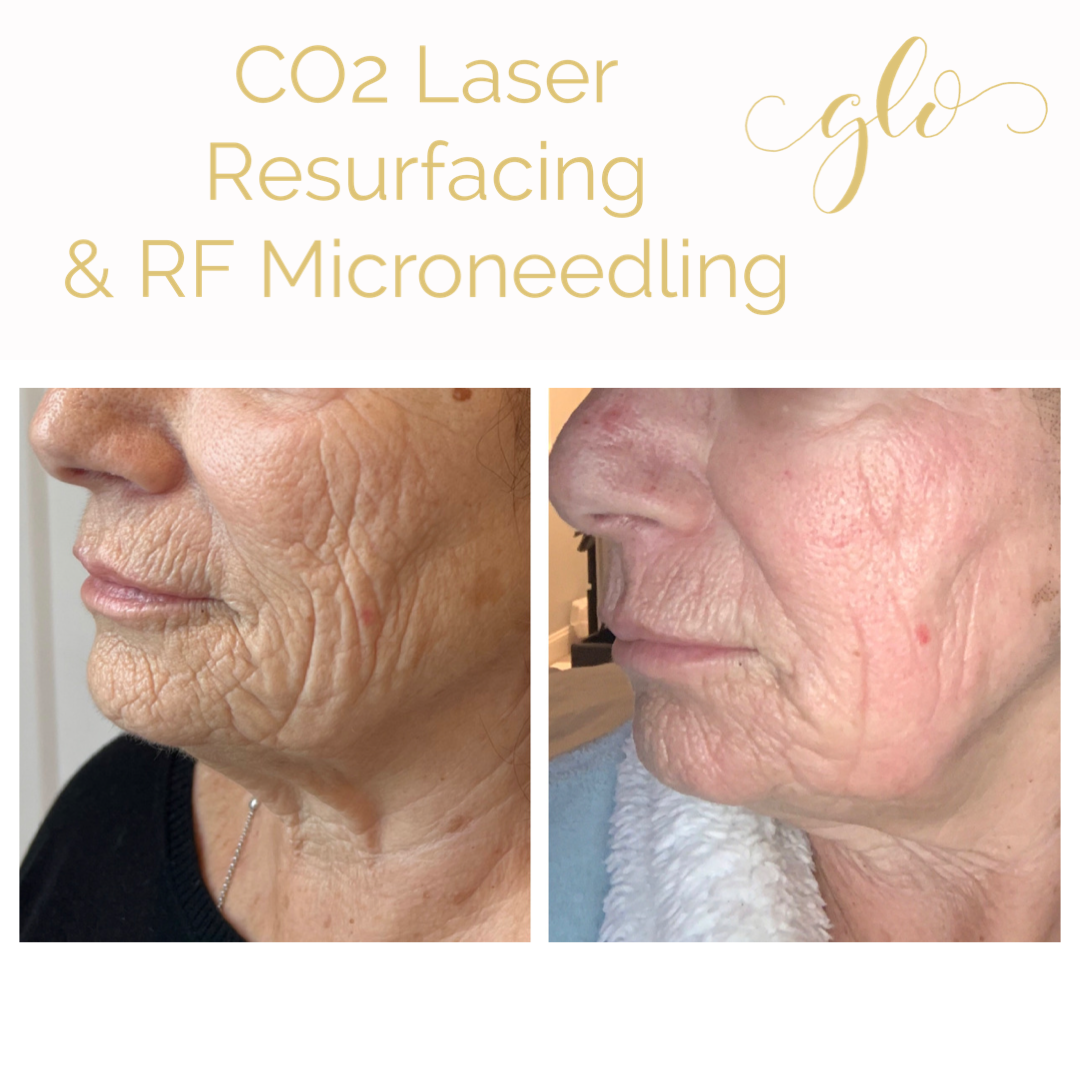 SecretPro – RF Microneedling & Co2 Laser Resurfacing