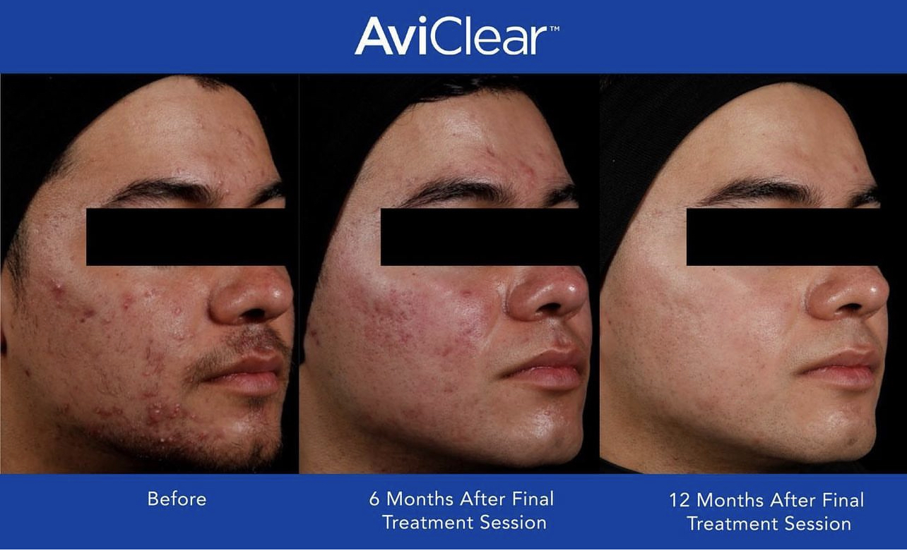 AviClear Treatment by Glo Aesthetics