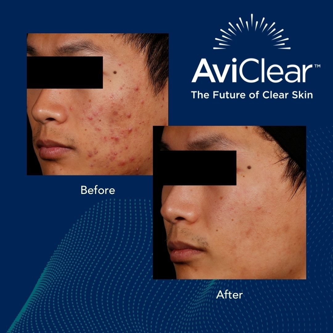 AviClear Glo Aesthetics