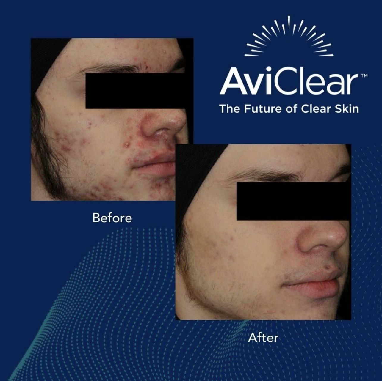 AviClear Glo Aesthetics