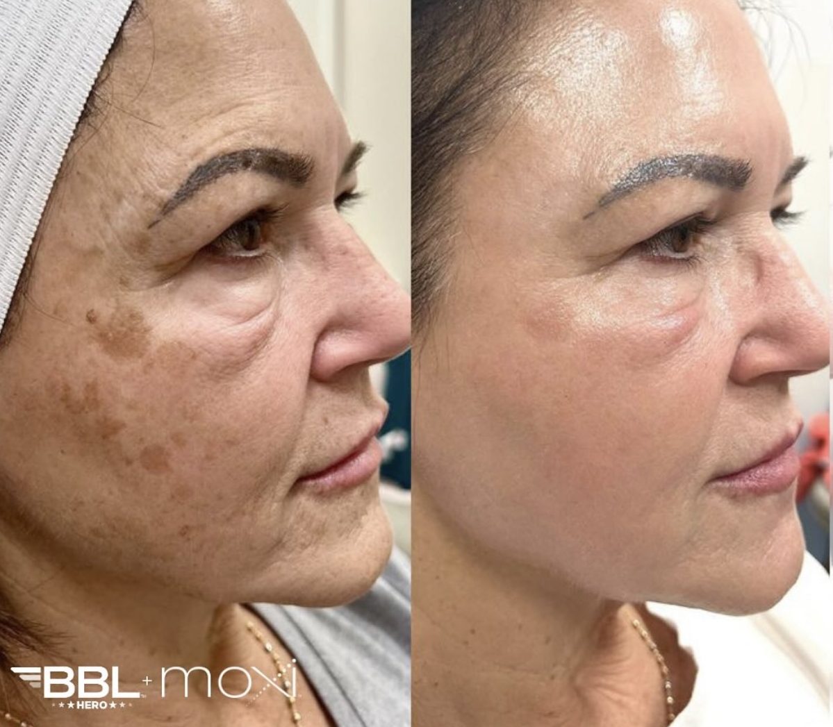 Sciton mJoule BBL and Moxi Treatment