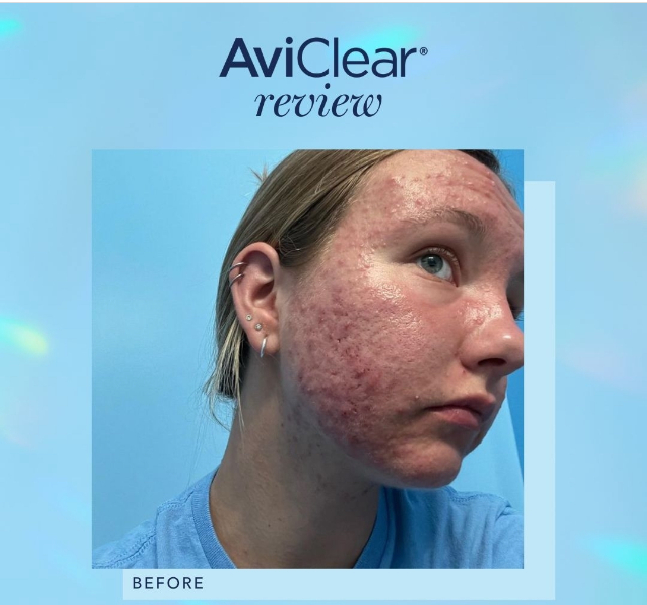 AviClear Review