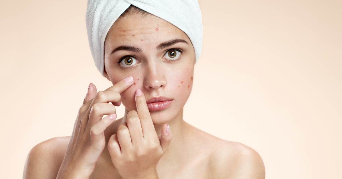 Top 5 Benefits of the ClearGLo Acne System for Oily and Acne-Prone Skin