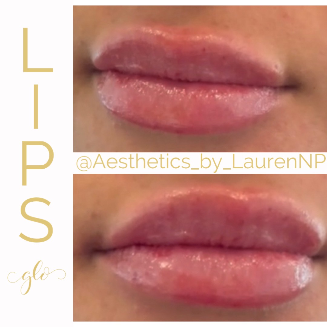 Dermal Filler Treatment by Glo Aesthetics